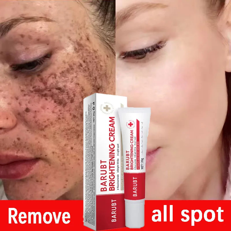 Powerful Spot-removing Whitening Cream Brighten Skin Fast Eliminates Melanin Pigmentation Melasma Dark Spots Korean Skin Care