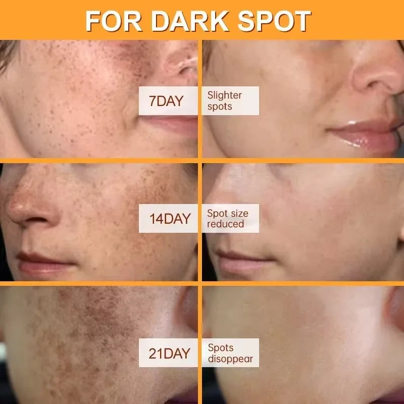 Effective Spot Removing Face Cream Whitening Freckle Remove Melasma Fade Melanin Anti-Pigmentation Improve Dullness Skin Care