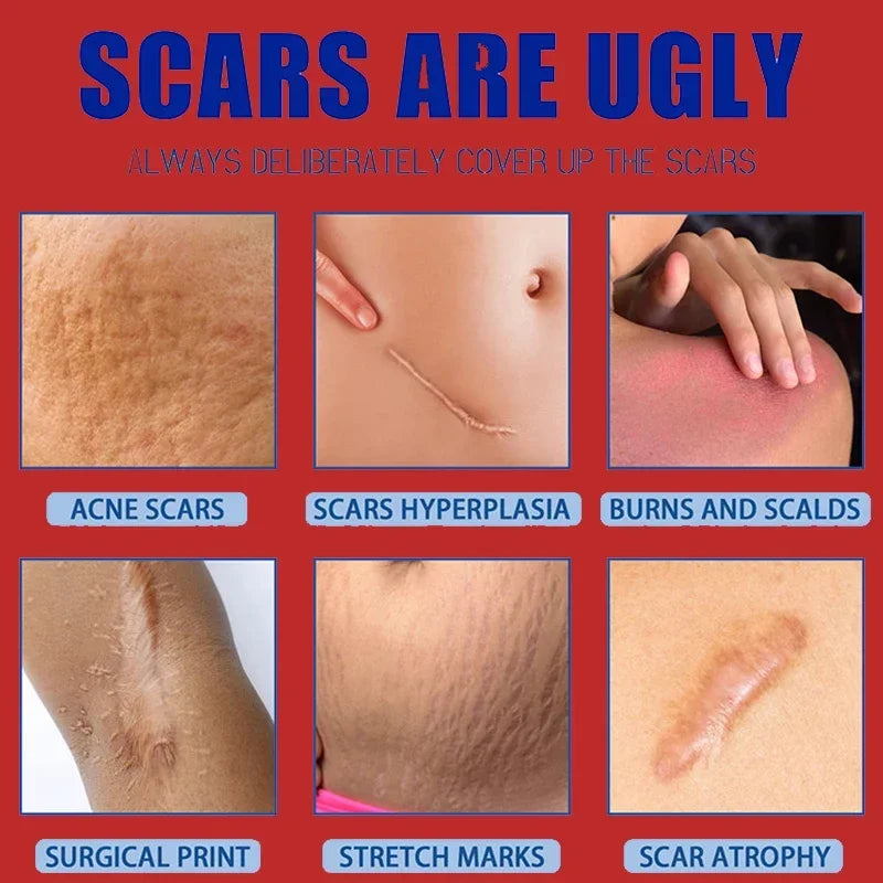 Effective Scar Removal Cream Fast Treatment Stretch Marks Burn Surgical Scars Acne Spots Repair Whitening Moisturizing Skin Care