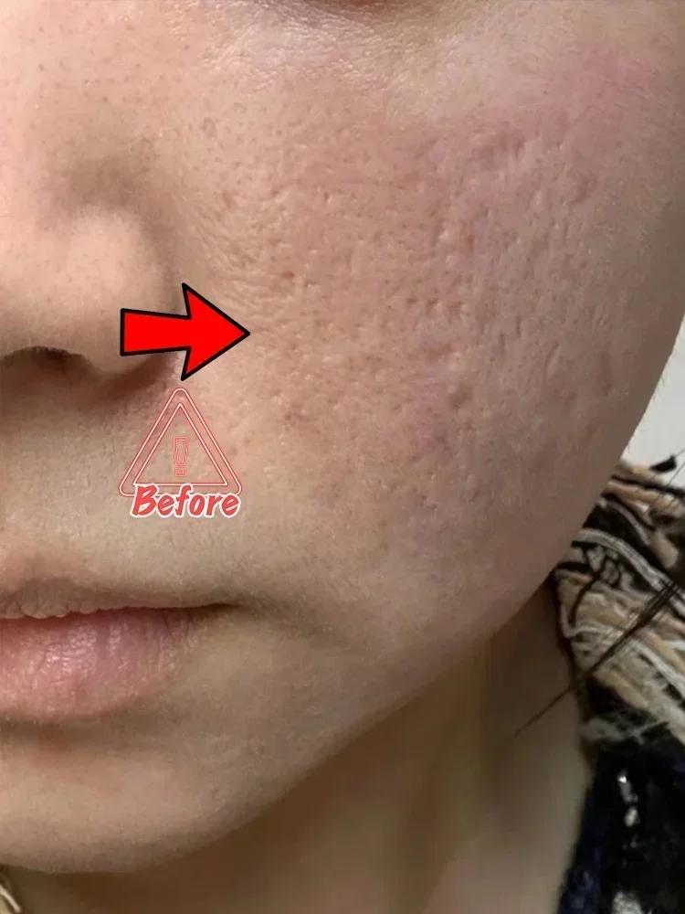 Acne-removing Imprints Acne-pits acne-Scars Paste hole filling regeneration shrink pores fade to eliminate acne-pits repair