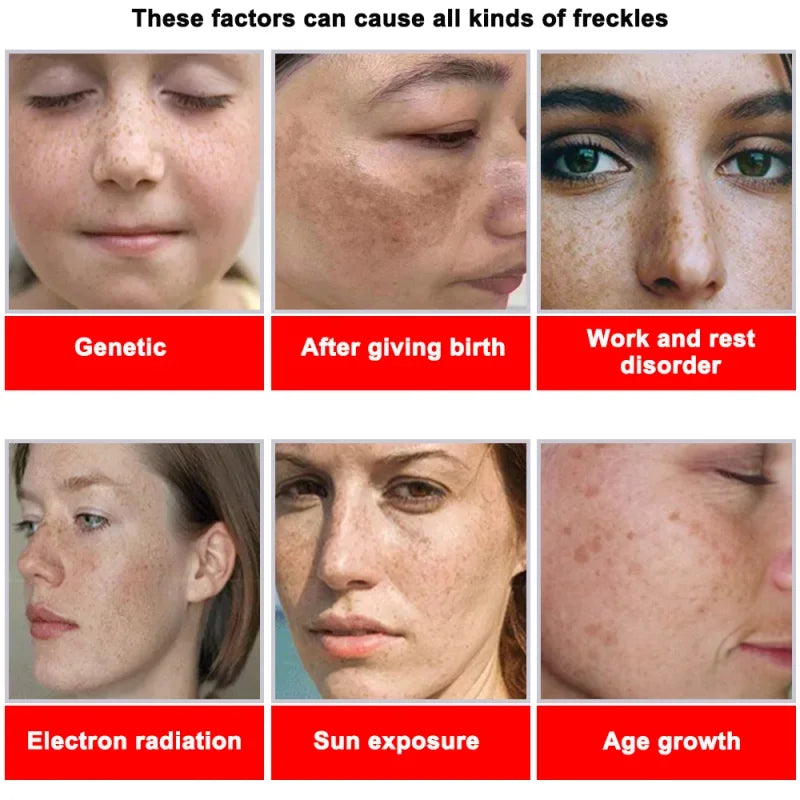Powerful Spot-removing Whitening Cream Brighten Skin Fast Eliminates Melanin Pigmentation Melasma Dark Spots Korean Skin Care