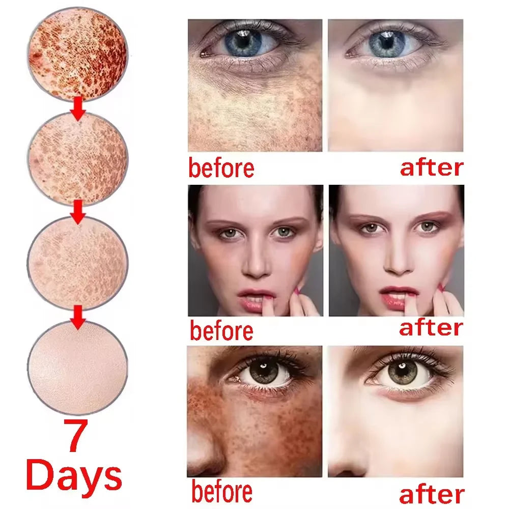 Effective Spot Removing Face Cream Whitening Freckle Remove Melasma Fade Melanin Anti-Pigmentation Improve Dullness Skin Care