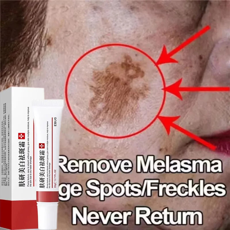 Effective Spot Removing Face Cream Whitening Freckle Remove Melasma Fade Melanin Anti-Pigmentation Improve Dullness Skin Care