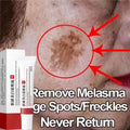 Effective Spot Removing Face Cream Whitening Freckle Remove Melasma Fade Melanin Anti-Pigmentation Improve Dullness Skin Care