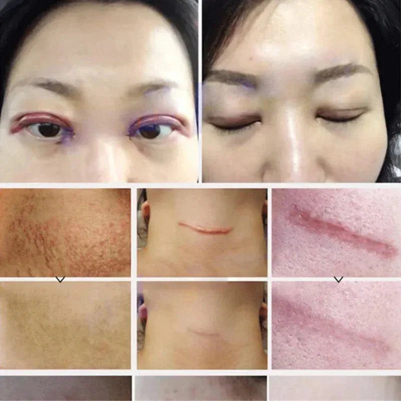Effective Scar Removal Cream Fast Treatment Stretch Marks Burn Surgical Scars Acne Spots Repair Whitening Moisturizing Skin Care