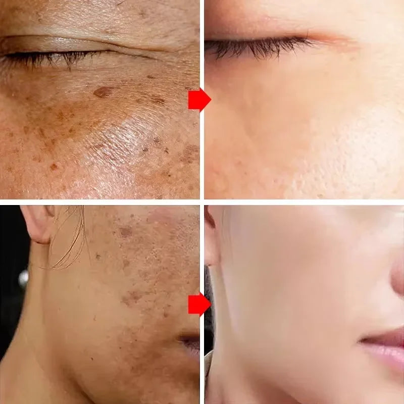 Effective Spot Removing Face Cream Whitening Freckle Remove Melasma Fade Melanin Anti-Pigmentation Improve Dullness Skin Care