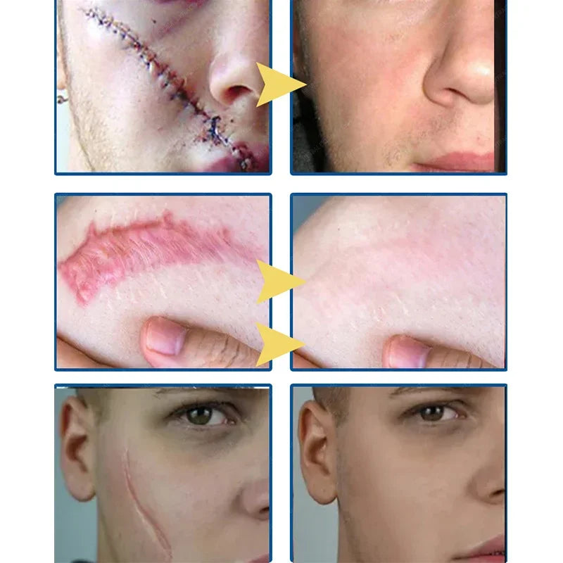 Effective Scar Removal Cream Fast Treatment Stretch Marks Burn Surgical Scars Acne Spots Repair Whitening Moisturizing Skin Care
